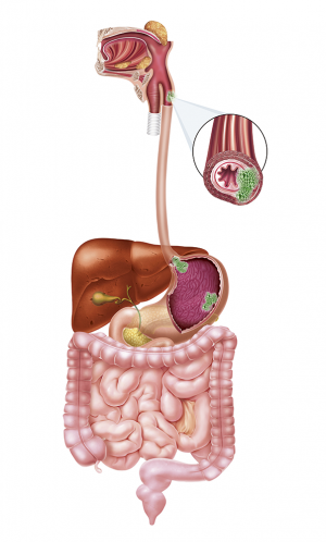 Câncer Estômago e Esôfago