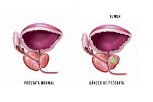 Câncer de Próstata